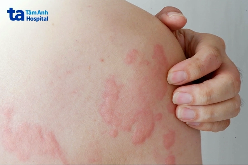 Vùng da bị nổi mẩn đỏ do phản ứng dị ứng hoặc nổi mề đay