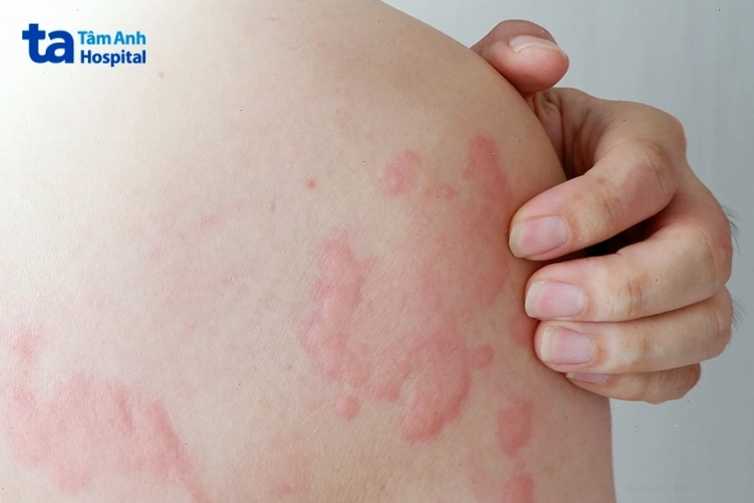 Vùng da bị nổi mẩn đỏ, sưng tấy do phản ứng dị ứng hoặc nổi mề đay