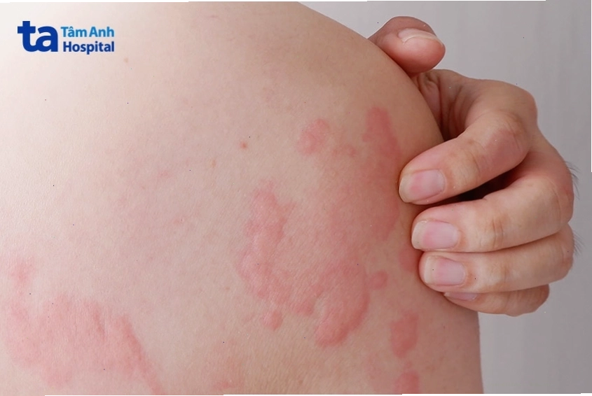 Vùng da bị nổi mẩn đỏ và ngứa do phản ứng dị ứng hoặc nổi mề đay