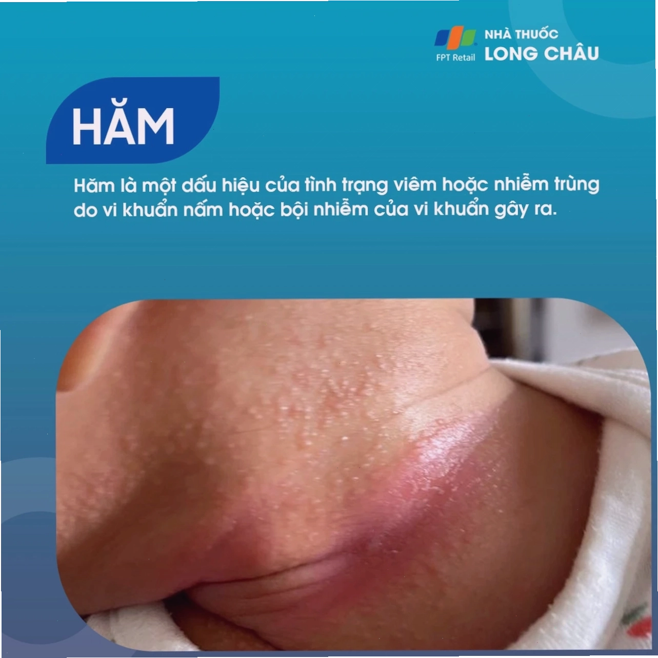 Vùng da dưới cánh tay bị hăm đỏ, ngứa rát ở người lớn