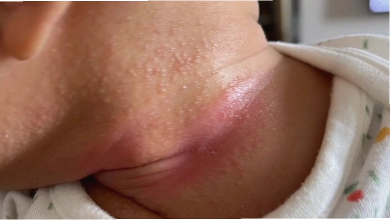 Vùng da dưới cánh tay bị hăm đỏ, nổi mẩn