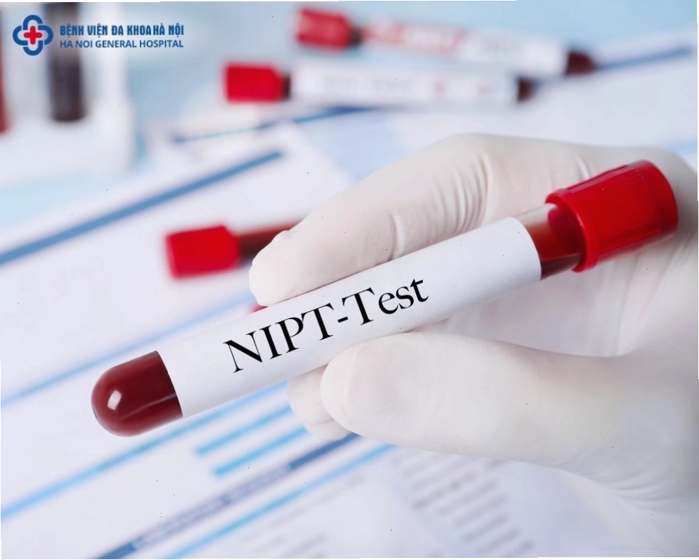 Xét nghiệm NIPT sàng lọc bất thường nhiễm sắc thể