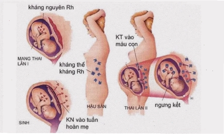 Bất đồng nhóm máu ở mẹ bầu Rh âm và thai nhi Rh dương