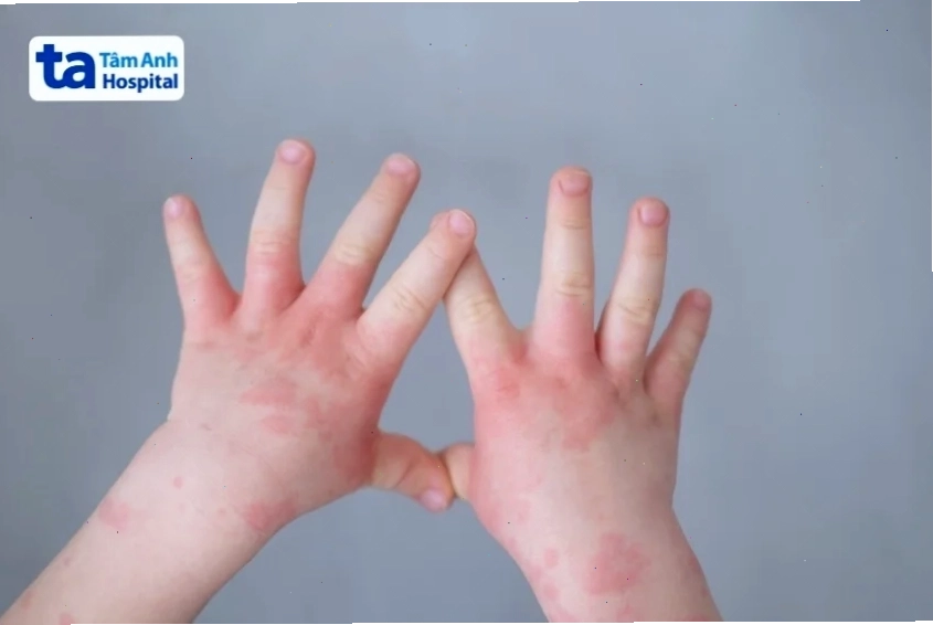 Các triệu chứng phổ biến khi bị dị ứng thức ăn