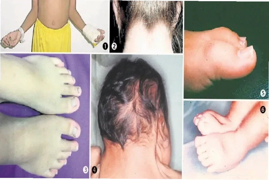 Hình ảnh bất thường ở vùng da gáy, tay, chân do hội chứng Turner