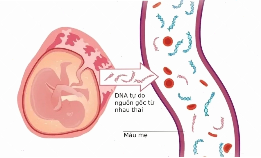 Xét nghiệm NIPT giúp sàng lọc các rối loạn NST
