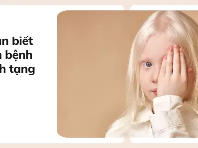 Cách nhận biết bệnh bạch tạng và phương pháp chăm sóc hiệu quả