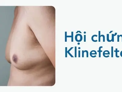 Hội chứng Klinefelter khiến nhiều người chủ quan bỏ qua