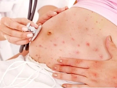 Bà bầu bị ngứa khắp người phải làm sao? Nguyên nhân và cách giảm ngứa hiệu quả