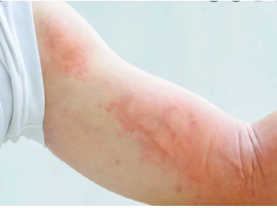 Bé Bị Nổi Mề Đay Khắp Người: Nguyên Nhân, Cách Xử Lý và Phòng Ngừa Hiệu Quả