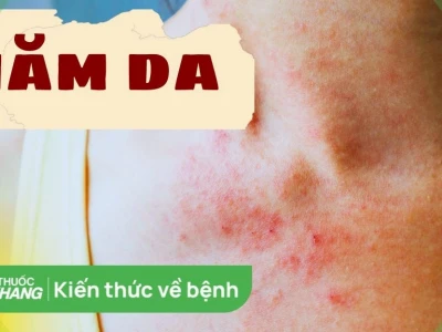 Bị hăm mông ở người lớn: Nguyên nhân, cách nhận biết và phòng ngừa hiệu quả