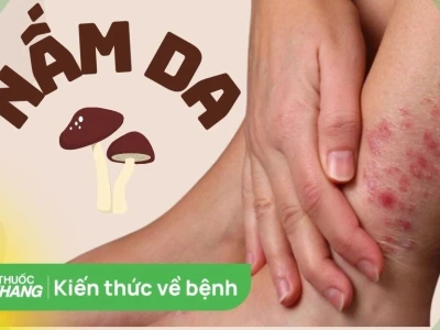 Bị nấm da trên người: Nguyên nhân, triệu chứng và cách điều trị hiệu quả 2026