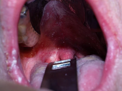 Bị nấm lưỡi ở người lớn: Nguyên nhân, dấu hiệu và cách điều trị hiệu quả 2026