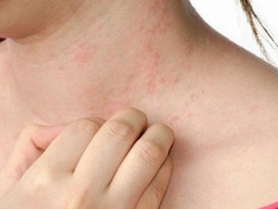 Bị nổi mẩn đỏ khắp người và ngứa: Nguyên nhân, cách xử lý và phòng ngừa