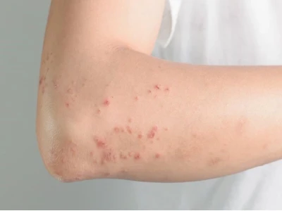 Bị nổi mề đay ngứa khắp người: Nguyên nhân, dấu hiệu và cách xử lý hiệu quả