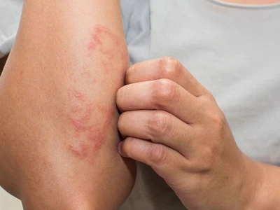 Bị Nổi Mụn Nước Ngứa Khắp Người Là Do Đâu Và Cách Xử Lý?