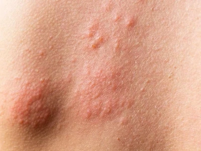 Biểu hiện HIV ngoài da: Nhận biết sớm các dấu hiệu bất thường