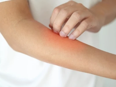 Bọ nhảy ở mèo có lây sang người không và cách phòng tránh hiệu quả