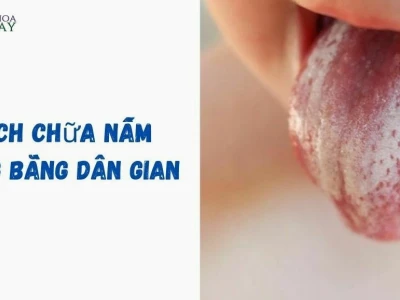 Cách chữa nấm lưỡi ở người lớn hiệu quả và an toàn