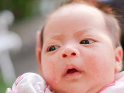 Cách trị mụn sữa ở người lớn: Nguyên nhân và giải pháp hiệu quả