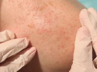 Cách trị rôm sảy ở người lớn tại nhà hiệu quả và nhanh chóng