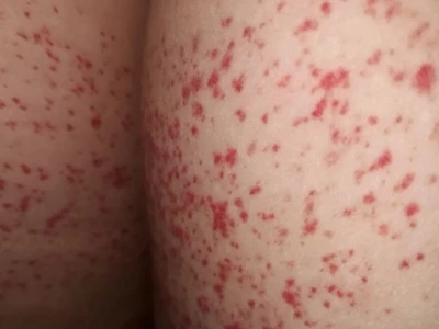 Da nổi chấm đỏ như nốt ruồi son không ngứa: Nguyên nhân và cách xử lý