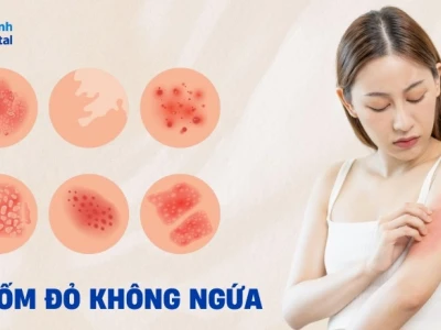 Da nổi mẩn đỏ khắp người nhưng không ngứa: Nguyên nhân và giải pháp