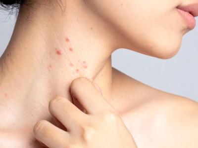 Da nổi mụn khắp người nhưng không ngứa: Nguyên nhân và cách xử lý