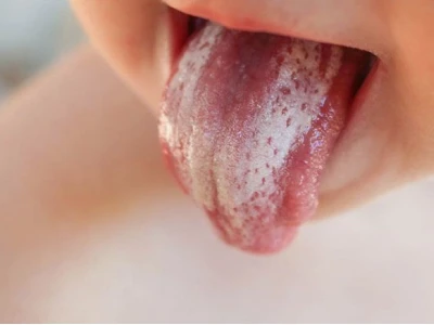 Điều Trị Nấm Lưỡi Ở Người Lớn: Nguyên Nhân, Triệu Chứng Và Phác Đồ Hiệu Quả