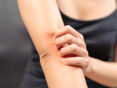 Ghẻ chó có lây sang người không và cách phòng tránh hiệu quả