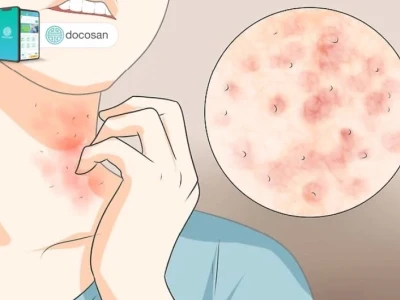 Ghẻ phỏng ở người lớn: Nguyên nhân, triệu chứng và cách điều trị hiệu quả