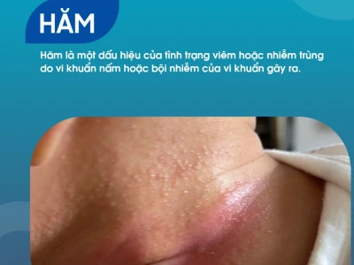 Giải pháp trị hăm vùng kín cho người lớn hiệu quả và an toàn