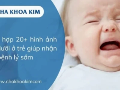 Hình ảnh nấm lưỡi ở người lớn: Nhận biết triệu chứng và cách xử lý hiệu quả