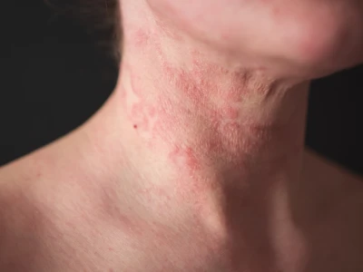 Hình ảnh viêm da cơ địa người lớn: Dấu hiệu nhận biết và giải pháp