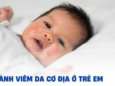 Hình ảnh viêm da cơ địa người lớn: Nhận biết, nguyên nhân và cách điều trị