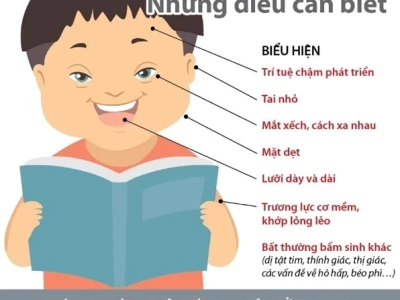 Hội chứng Down: Nguyên nhân, dấu hiệu và cách chăm sóc người bệnh