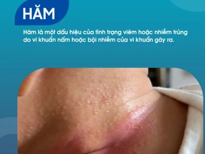 Kem trị hăm cho người lớn: Lựa chọn nào tốt nhất năm 2026?