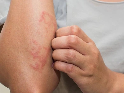Mọc mụn ngứa khắp người: Nguyên nhân, dấu hiệu nhận biết và cách xử lý hiệu quả