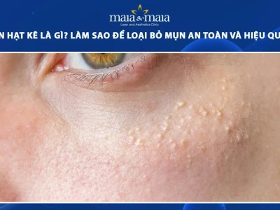 Mụn Hạt Kê Ở Người Lớn: Nguyên Nhân, Nhận Biết và Cách Xử Lý Hiệu Quả