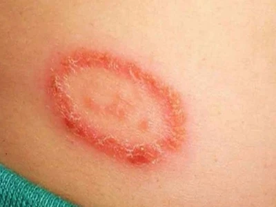 Nấm Đồng Xu Ở Người: Triệu Chứng, Nhận Biết và Cách Điều Trị Hiệu Quả