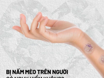 Nấm mèo ở người có tự khỏi không và cách xử lý hiệu quả