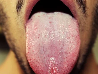 Nấm Miệng Ở Người Lớn: Triệu Chứng, Nguyên Nhân và Cách Điều Trị Hiệu Quả