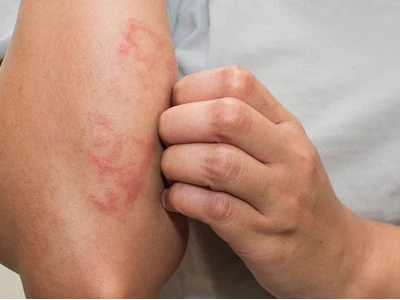 Ngứa gãi nổi cục: Nguyên nhân, dấu hiệu và cách xử lý hiệu quả