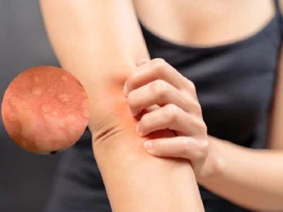 Ngứa Râm Ran Khắp Người Vào Ban Đêm: Nguyên Nhân và Cách Xử Lý Hiệu Quả