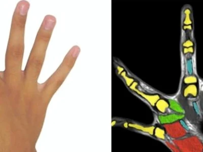Người có 6 ngón chân tốt hay xấu: Giải mã ý nghĩa theo nhân tướng học và y khoa