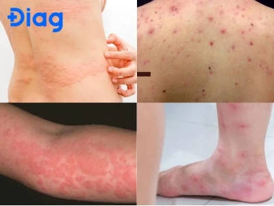 Người Hay Bị Ngứa Là Bệnh Gì? Nguyên Nhân Và Cách Khắc Phục