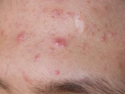 Người Hay Nổi Mụn Nhọt Là Bị Bệnh Gì? Nguyên Nhân Và Cách Điều Trị Hiệu Quả