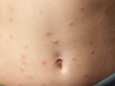 Người mọc mụn nước ngứa: Nguyên nhân và cách xử lý hiệu quả