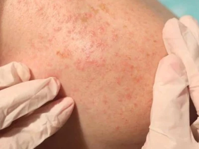 Nguyên nhân bị rôm sảy ở người lớn và cách xử lý hiệu quả