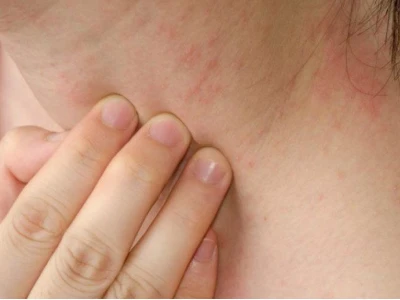 Nổi Ban Đỏ Ngứa Khắp Người: Nguyên Nhân, Cách Xử Lý và Phòng Ngừa